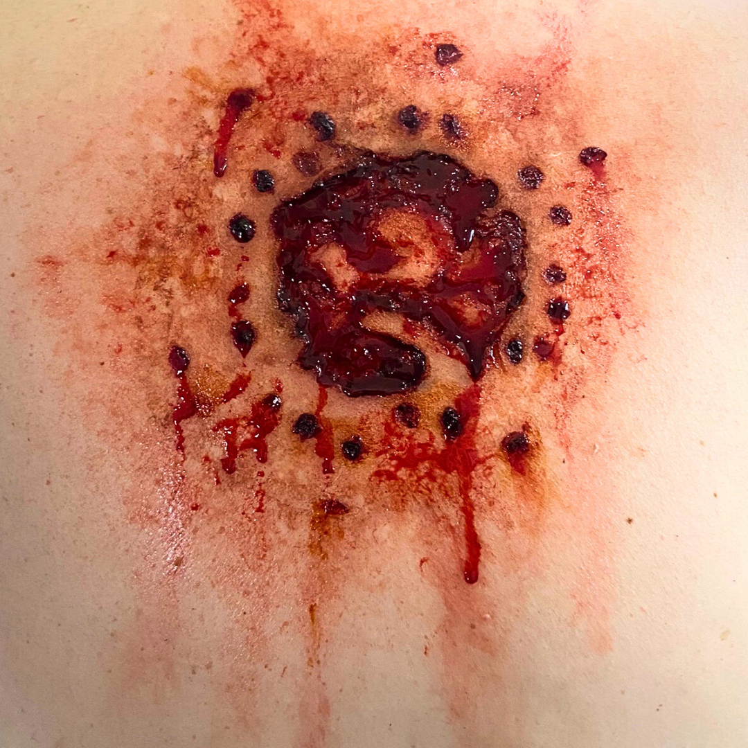  GUNSHOT / BULLET WOUNDS