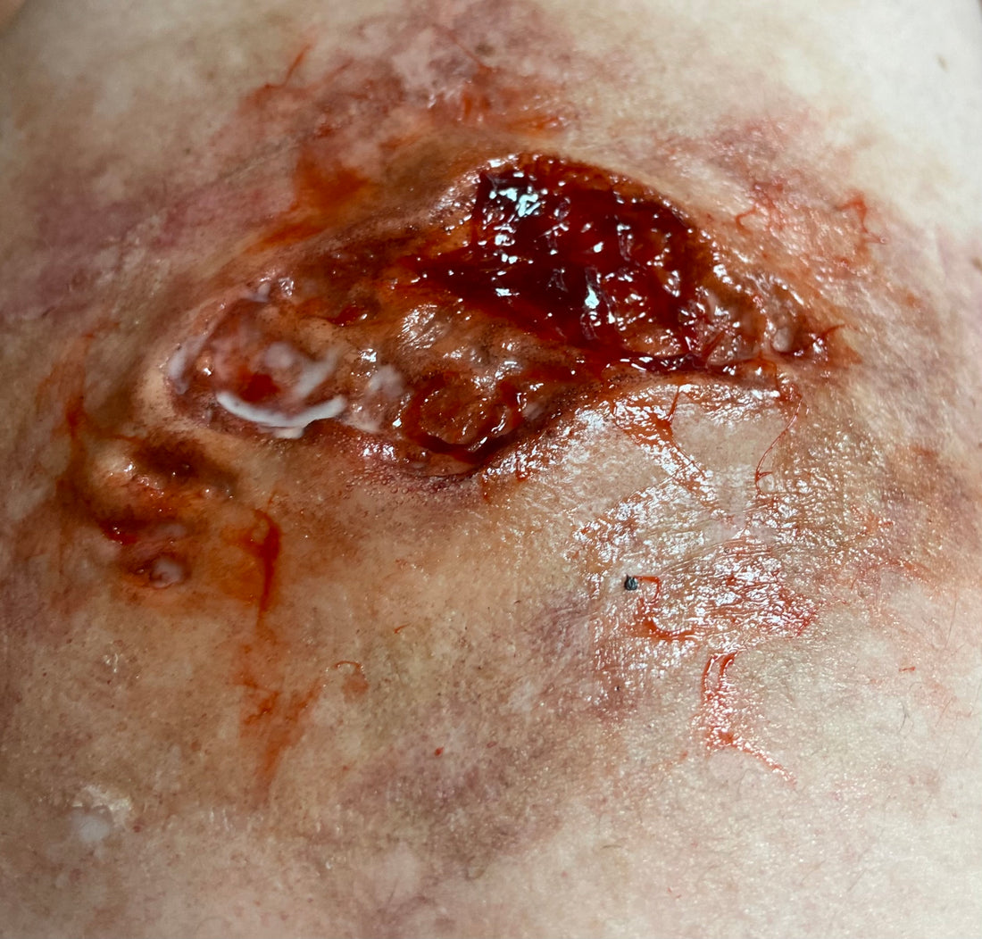  SKIN DISEASE & BURNS