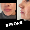 Botched Lips: Extreme