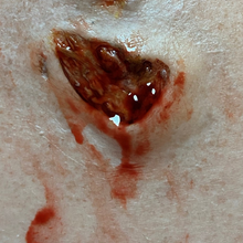  Skin Wound 1