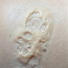 Skin Disease Wound 1