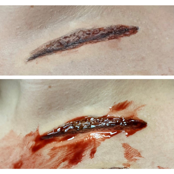 Skin Wound 8