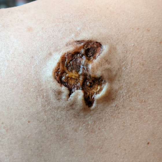 Skin Wound 4