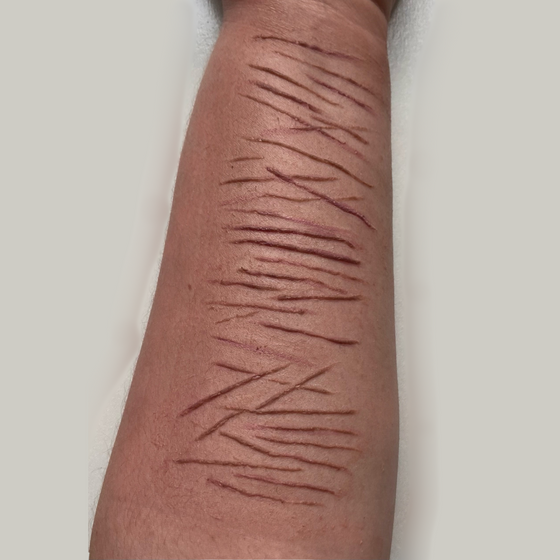 Healed Scars Bondo Mould