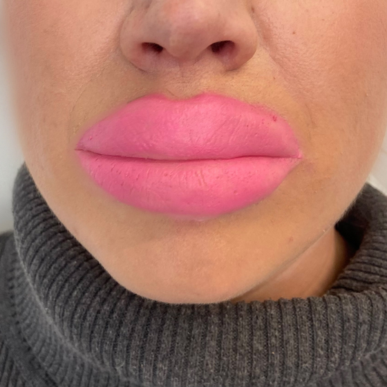 Botched Lips: Large