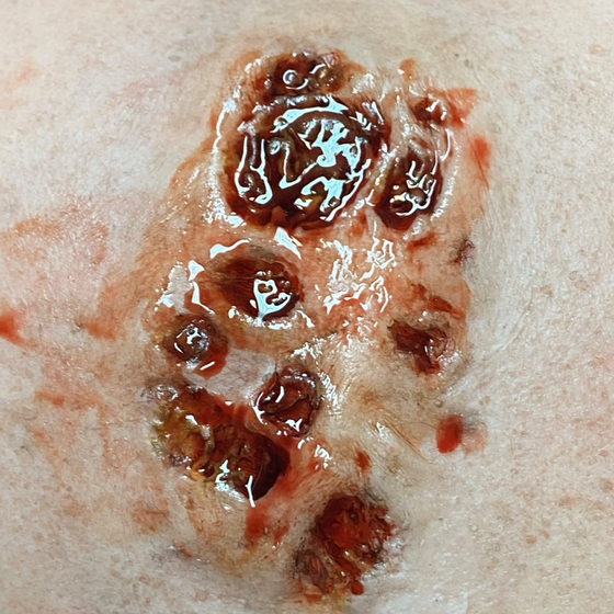 Skin Disease Wound 1