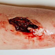  Skin Wound 2