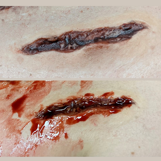Skin Wound 10