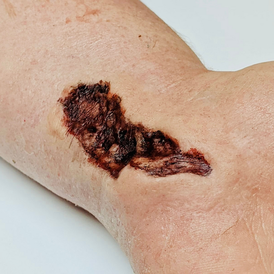 Skin Wound 3