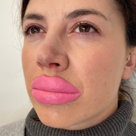 Botched Lips: Large
