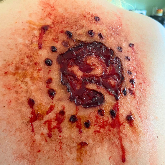 Shotgun Wound 1