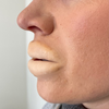 Botched Lips: Large
