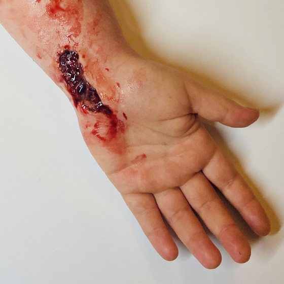 Skin Wound 3
