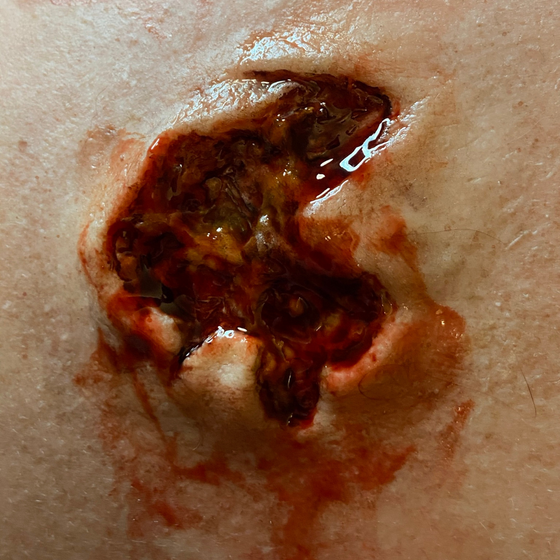 Skin Wound 4