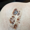 Skin Disease Wound 1
