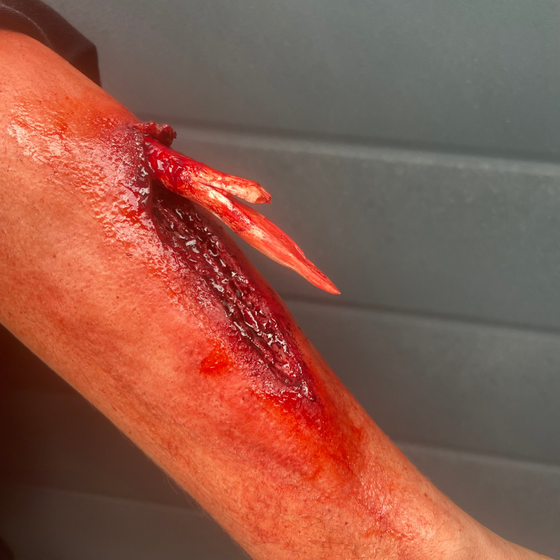 The Compound Fracture