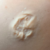 Skin Wound 4