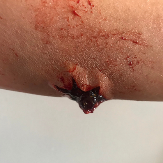 The Explosive Exit Wound
