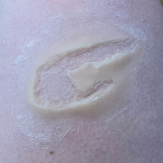 Skin Wound 5