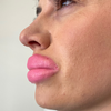 Botched Lips: Large