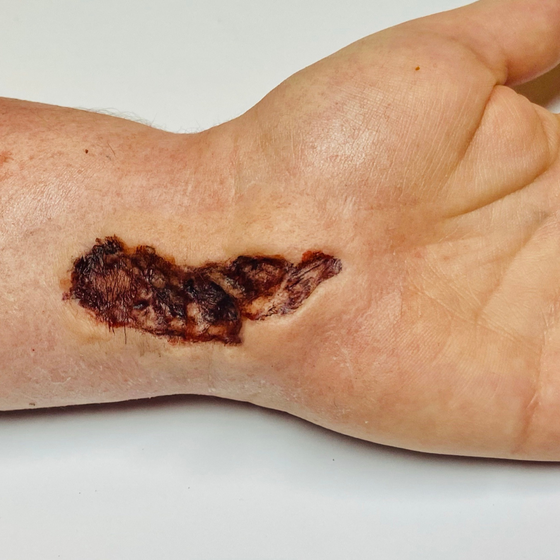 Skin Wound 3