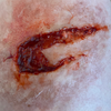 Skin Wound 5