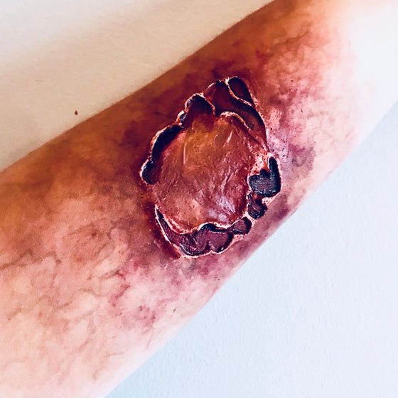 The Zombie Bite
